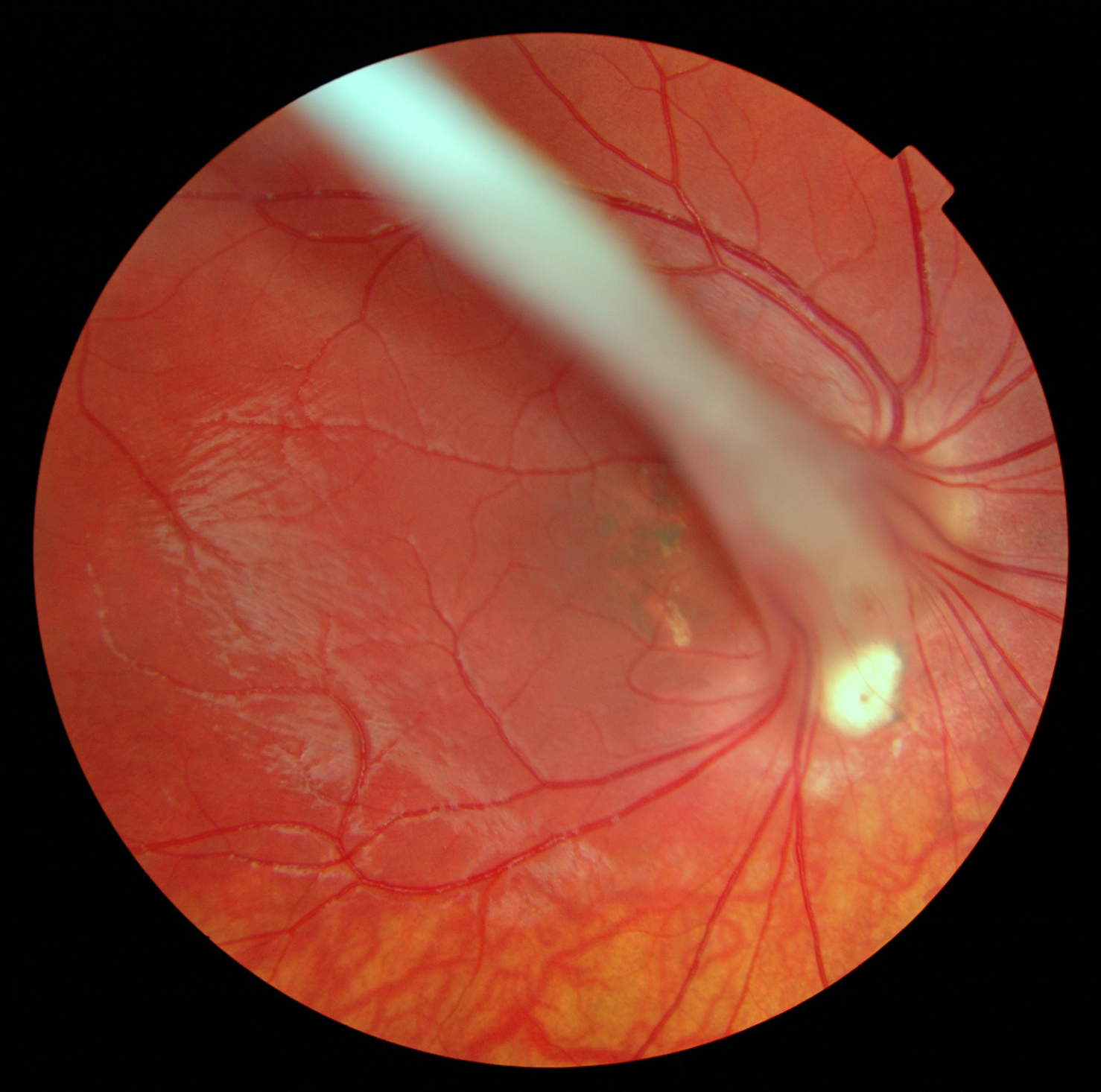  Persistent Hyaloid Artery 