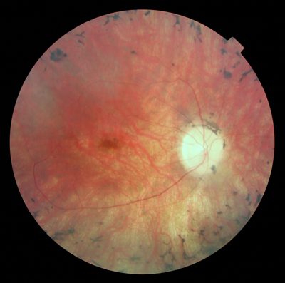  Retinitis Pigmentosa 