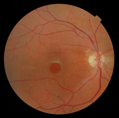  Macular Hole 