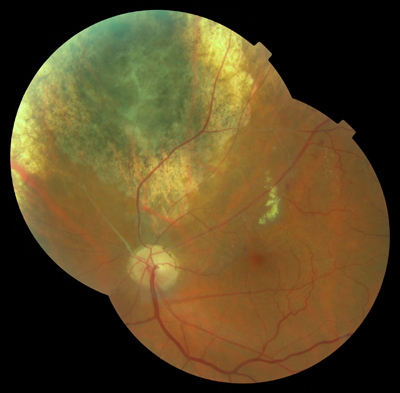  Choroidal Melanoma 