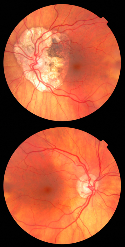  Peripapillary Atrophy 