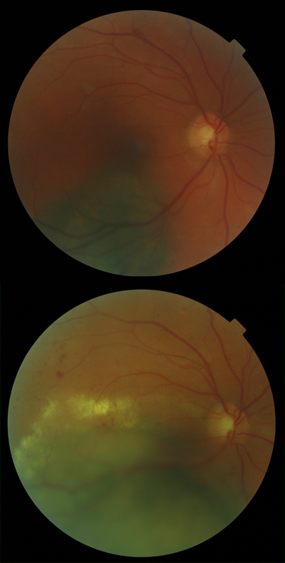  Choroidal Melanoma Progression 