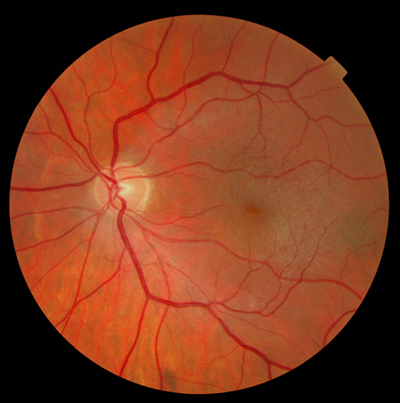  Retinal Detachment Post Cryo 