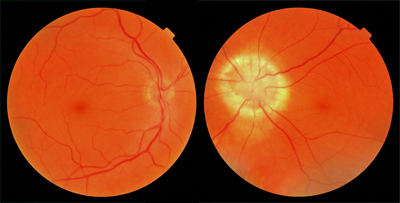  Congenital Disc Defect 