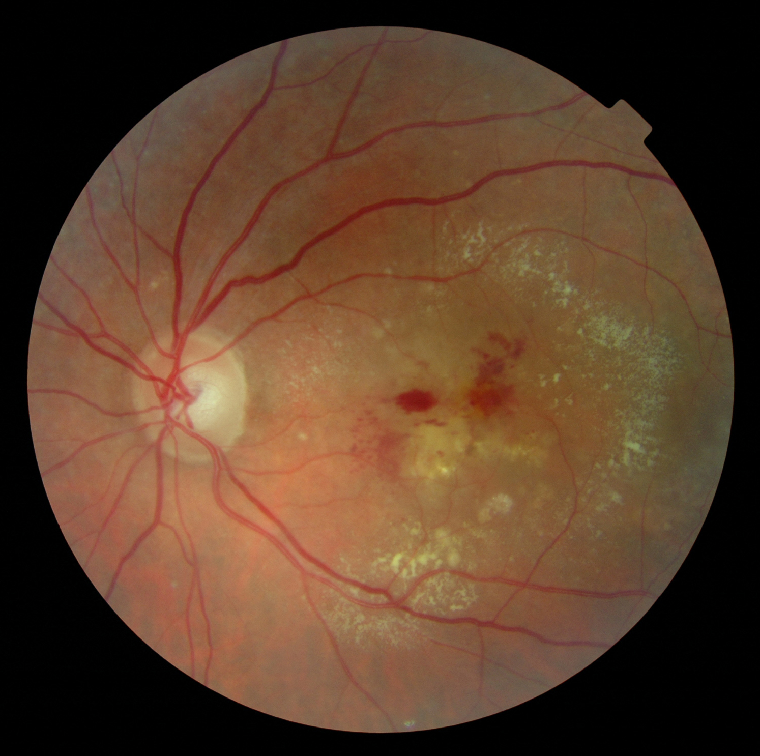 Macular Heamorrhage with Circinate Exudate