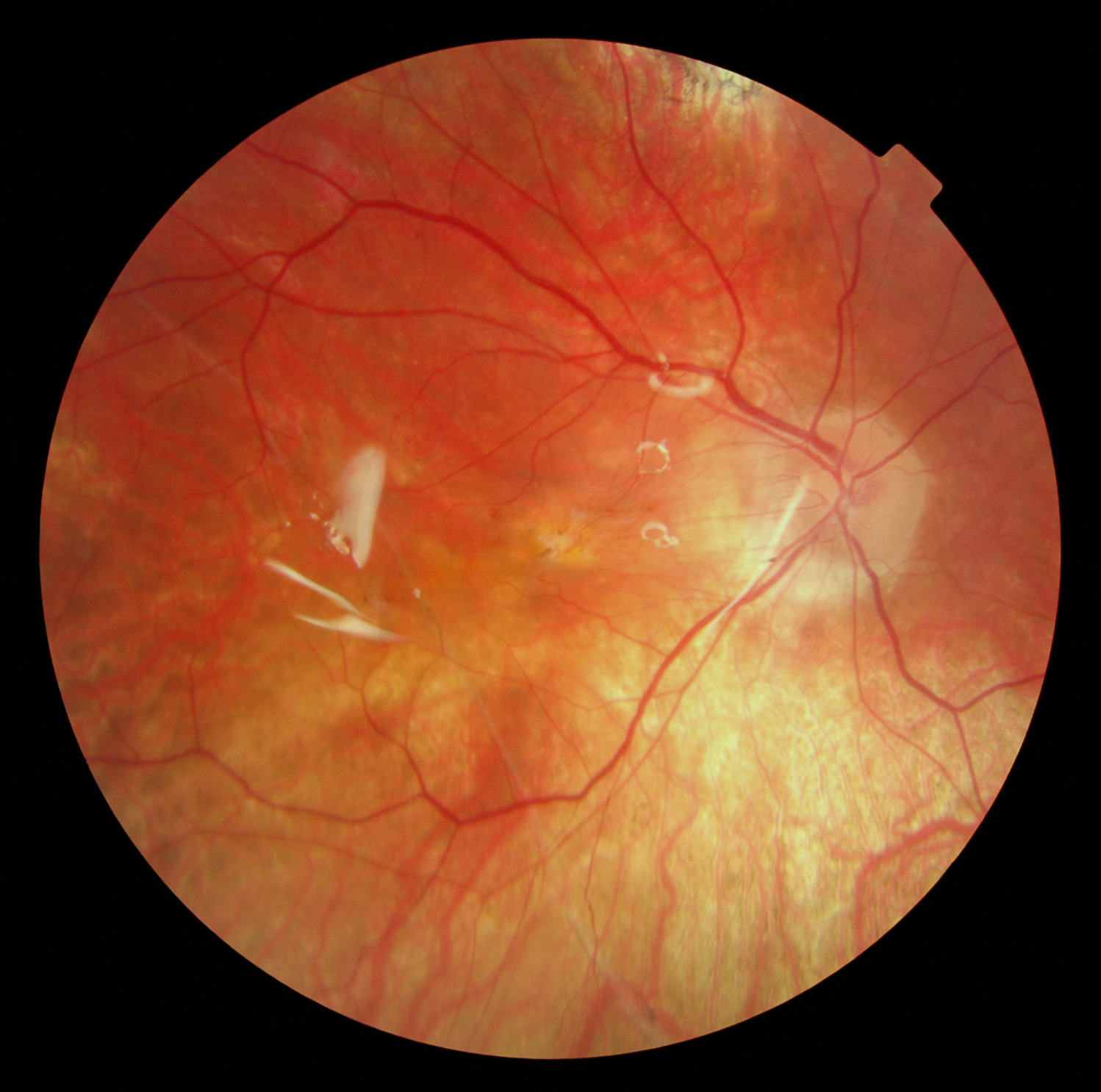 Retinal Detachment with Silicon Oil Vitrectomy