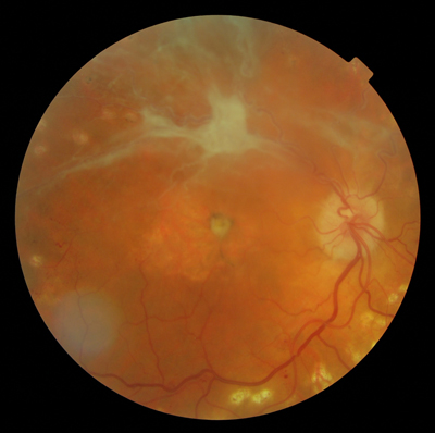 Old Retinal Detachment