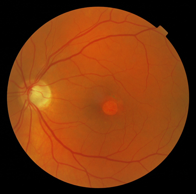 Central Serous Retinopathy with Pigment Epithelium Detachment