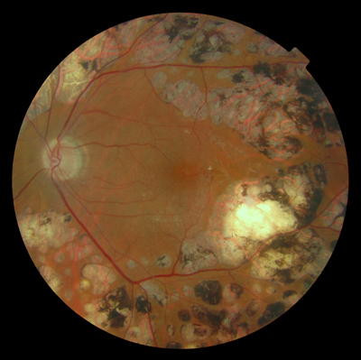 Pan Retinal Photocoagulation