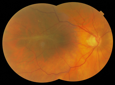 Epiretinal Membrane