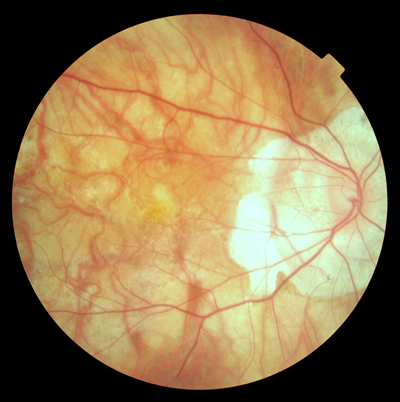 Myopic Degeneration