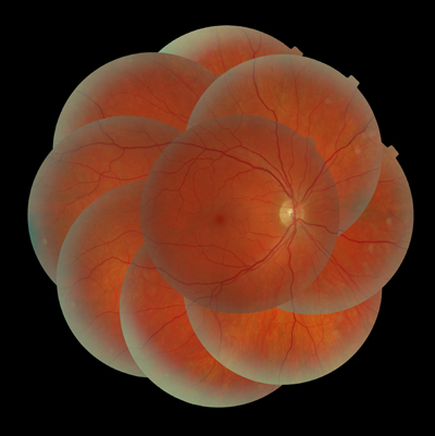Digital Retinal Imaging Mosaic